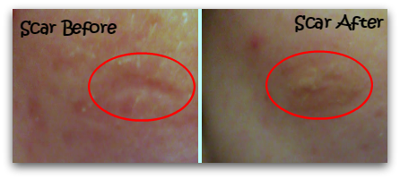 worryless by Dermaflage Before and After
