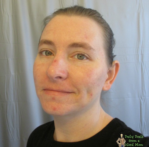 Treating Moderate to Severe Acne